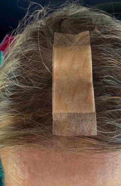 Head Wound Living with the People Inside